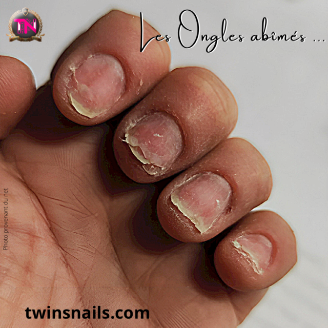 LES ONGLES ABIMES Twins Nails Prothésiste Ongulaire Les Pennes Mirabeau